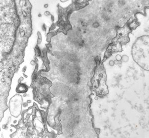 F,49y. | membranous glomerulopathy F,49y. | membranous glomerulopathy